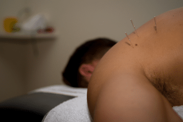 Dry Needling